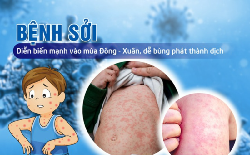 Kiểm soát, ngăn ngừa bệnh sởi lây lan